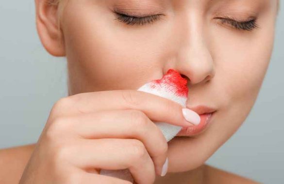 Causes courantes des saignements de nez : tout savoir sur les épistaxis